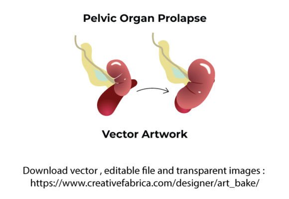 Pelvice Organ Prolaps Vector SVG PNG: A Designer’s Real-Talk Review